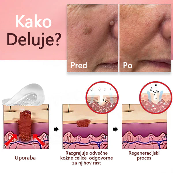 KUBOZN® Nano-mikroigelni obliži – neboleča in naravna rešitev za odstranjevanje kožnih izrastkov, bradavic in znamenj kar doma, brez brazgotin ✨