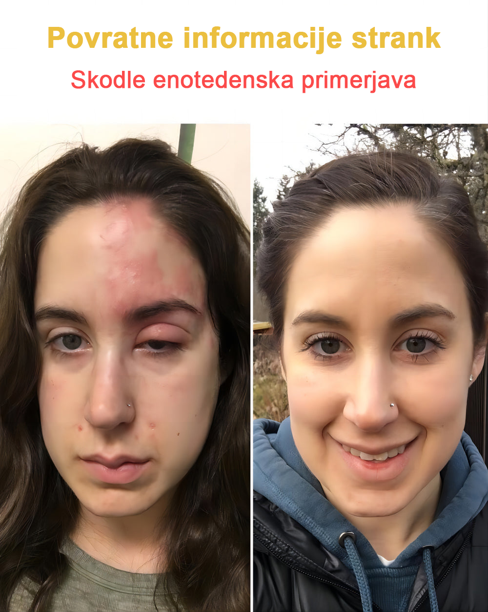 𝑽𝒆𝒍𝒊𝒔𝒔𝒆™ 2024 (priporoča AAD), za odstranjevanje bradavic, aken in brazgotin. Zdravi različne kožne bolezni