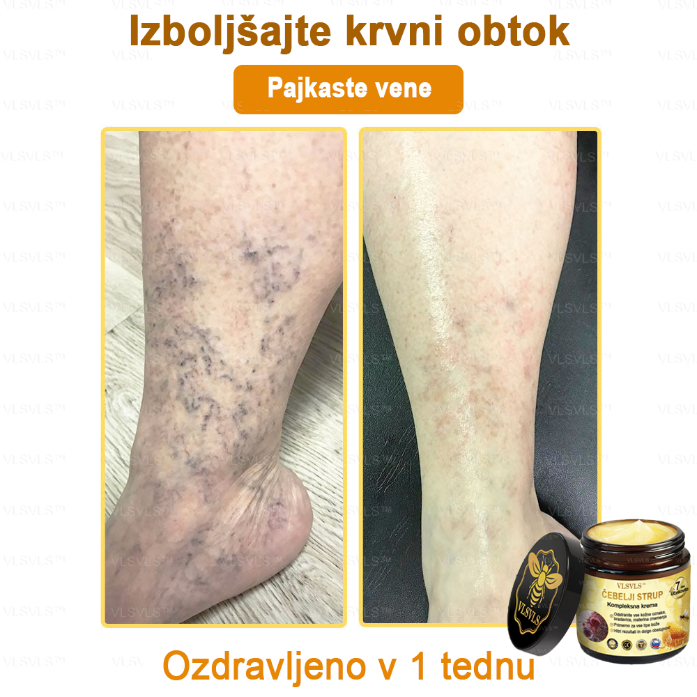 VLSVLS™ krema s čebeljim strupom s polnim učinkom 🧑⚕️ Priporočajo dermatologi - za zdravljenje različnih kožnih težav🐝