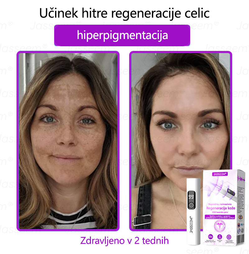 𝐉𝐚𝐬𝐬𝐞𝐞𝐦® Napredni neinvazivni CO₂ laserski pisalo za obnovo kože 🛫 (Nežno odstrani bradavice, materina znamenja, starostne pege in kožne izrastke – brez bolečin in brez kompliciranja!)