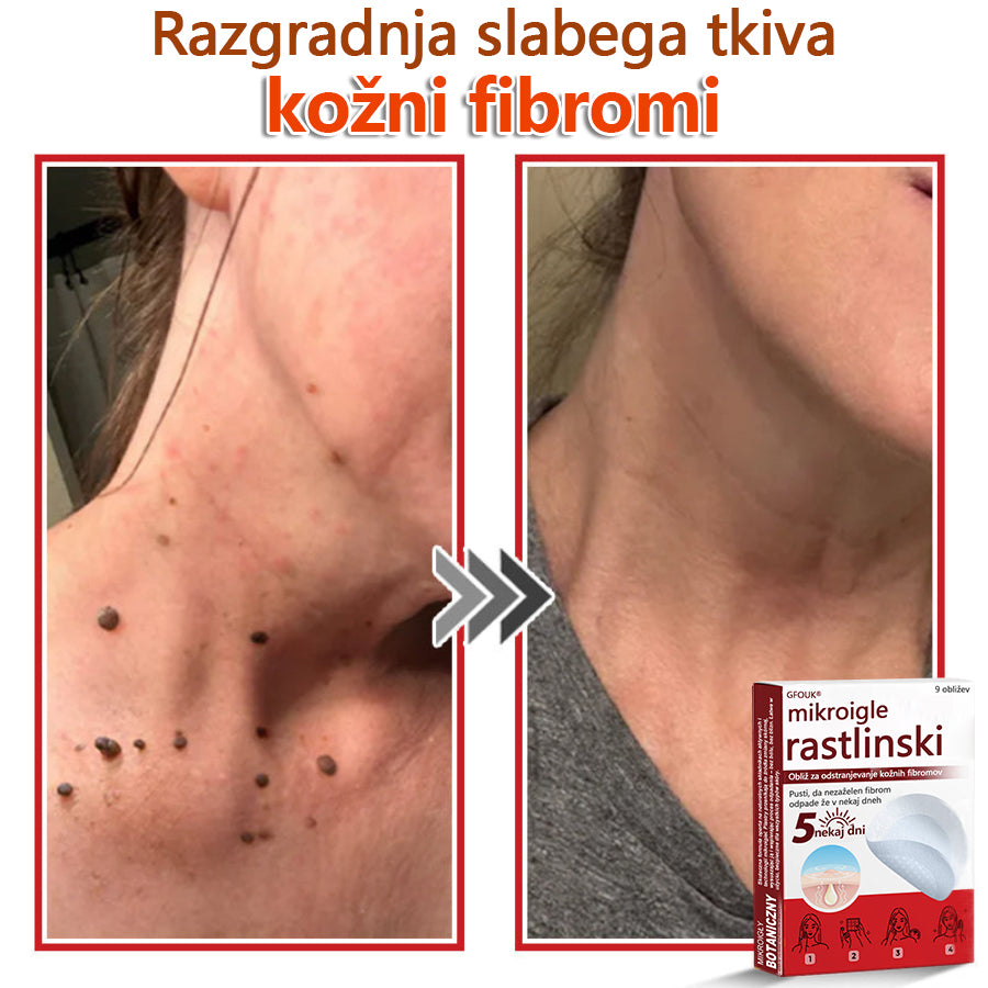 👨⚕️ GFOUK® MicroNeedle obliž za odstranjevanje kožnih izrastkov 🇪🇺 Skupno z EU smernicami za nego kože