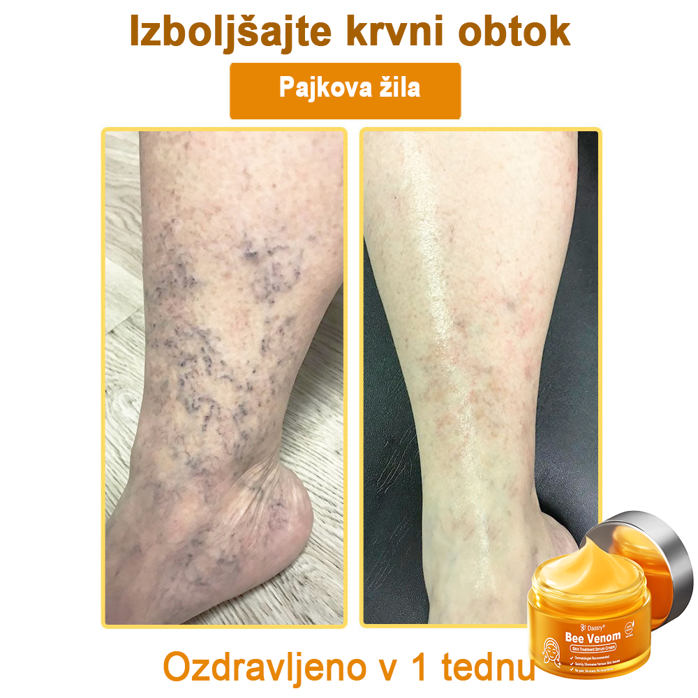 Daasry® Cebelji Strup Kožna Terapija Serum Krema👨⚕️ (Primerno za vse starosti & priporočeno s strani EMA)