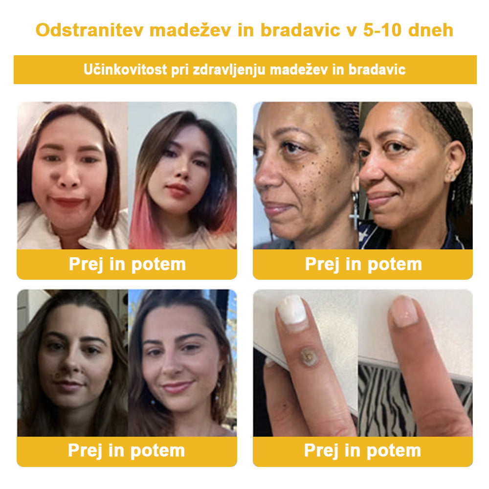 ✨🎁𝑭𝑹𝑶𝑷𝑼𝑵™ krema za odstranjevanje znamenj in madežev (85% popust zadnji dan dogodka)