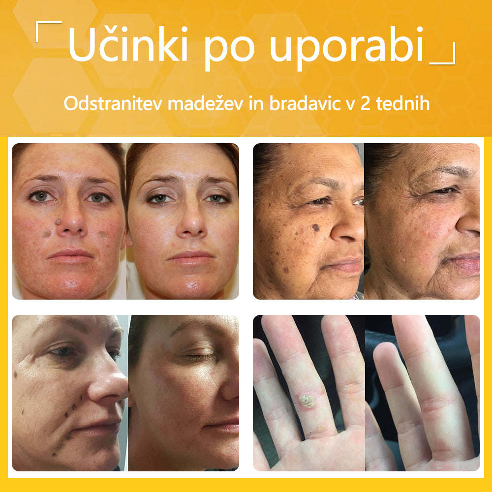 🐝Twinsun™ Izjemno Močna Krema z Čebeljim Strupom, s certifikatom EMA💖 Za zdravljenje bradavic, kožnih izrastkov, okužb in keratoze, ter za glajenje neenakomerne kože