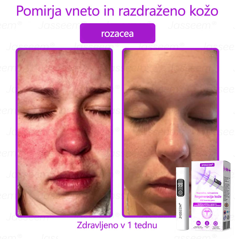 𝐉𝐚𝐬𝐬𝐞𝐞𝐦® Napredni neinvazivni CO₂ laserski pisalo za obnovo kože 🛫 (Nežno odstrani bradavice, materina znamenja, starostne pege in kožne izrastke – brez bolečin in brez kompliciranja!)