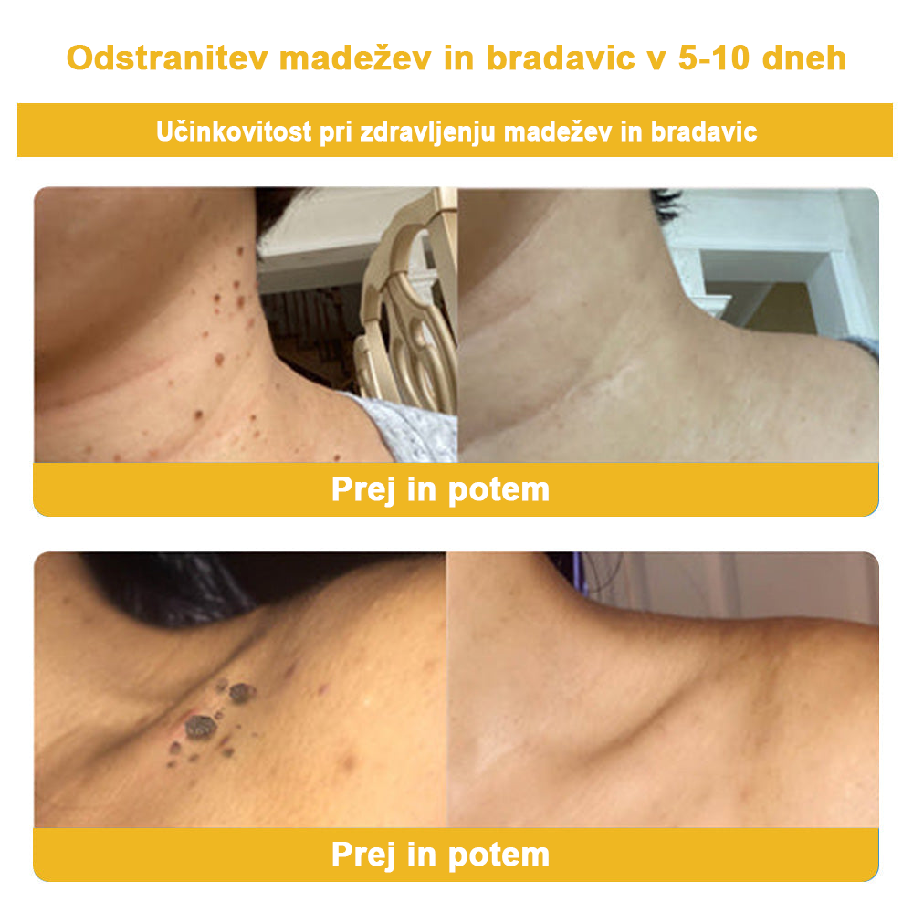 ✨🎁𝑭𝑹𝑶𝑷𝑼𝑵™ krema za odstranjevanje znamenj in madežev (85% popust zadnji dan dogodka)