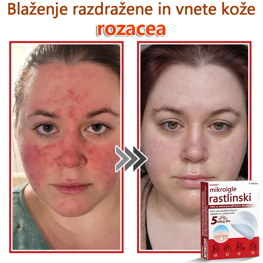 👨⚕️ GFOUK® MicroNeedle obliž za odstranjevanje kožnih izrastkov 🇪🇺 Skupno z EU smernicami za nego kože