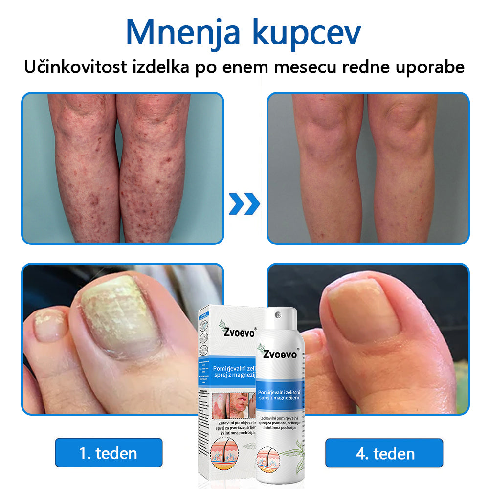 ✅ Uradna trgovina: Zvoevo® Magnezijev zeliščni sprej za luskavico ⚕️ EMA certificirano (lajša luskavico in ekcem, izboljšuje bakterijske okužbe na genitalnem področju, zdravi akne in bradavice, lajša bolečine v sklepih in nevropatske bolečine)