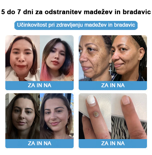 🐝 Krema Lenaro™ za zdravljenje madežev in bradavic 💎💎💎Primerna za vse starostne kategorije🐝