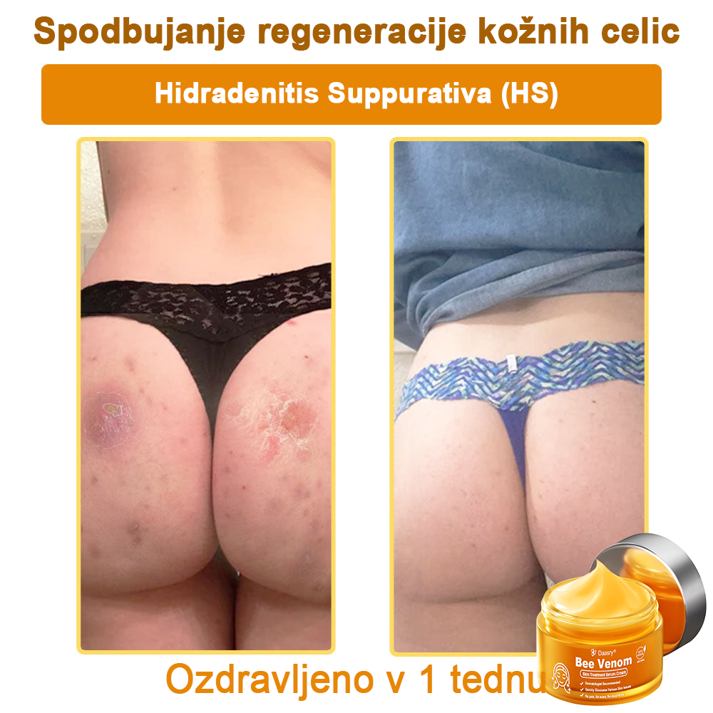 Daasry® Cebelji Strup Kožna Terapija Serum Krema👨⚕️ (Primerno za vse starosti & priporočeno s strani EMA)