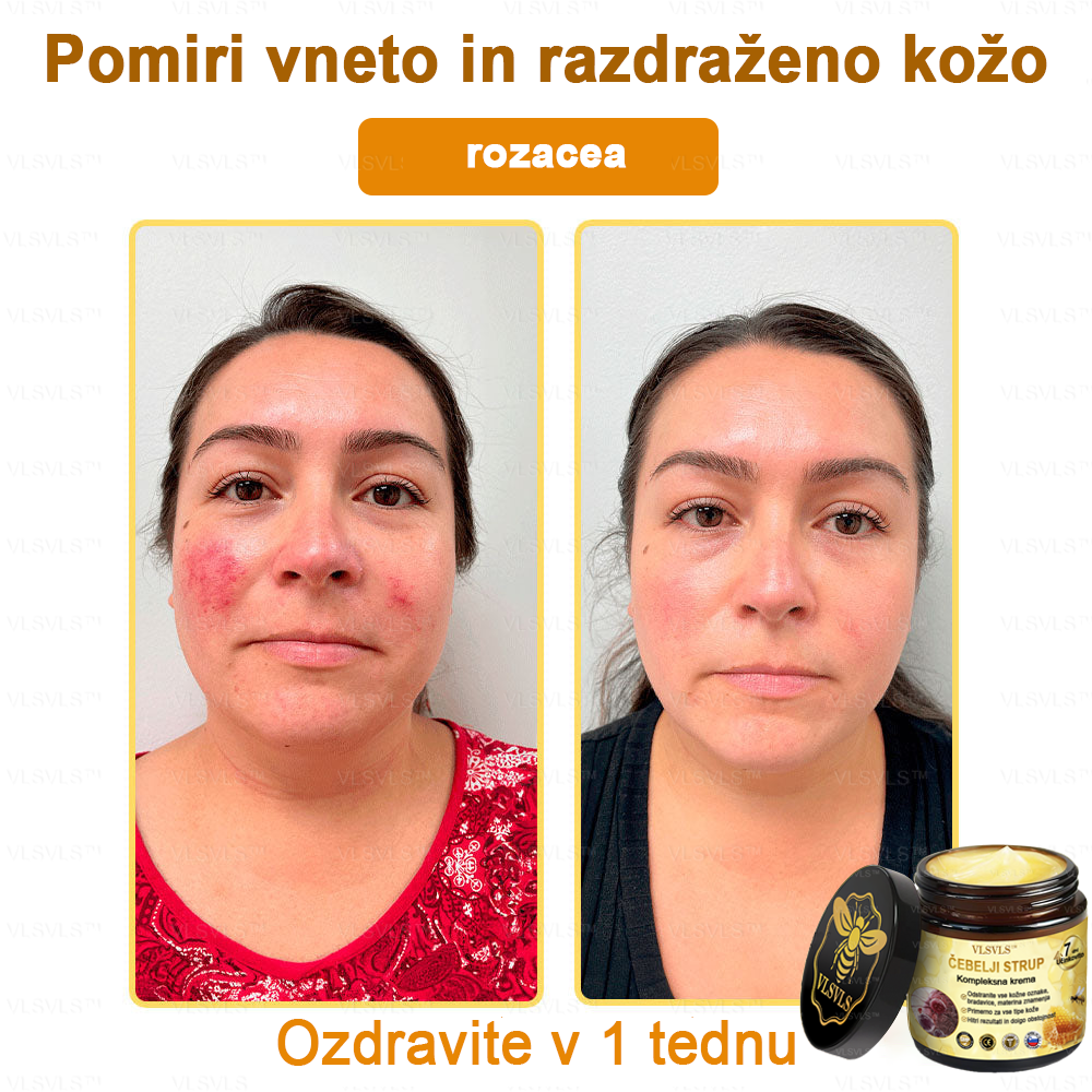 VLSVLS™ krema s čebeljim strupom s polnim učinkom 🧑⚕️ Priporočajo dermatologi - za zdravljenje različnih kožnih težav🐝