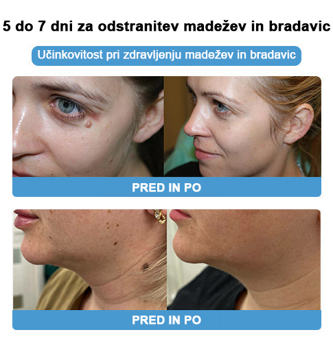 🐝 Krema Lenaro™ za zdravljenje madežev in bradavic 💎💎💎Primerna za vse starostne kategorije🐝
