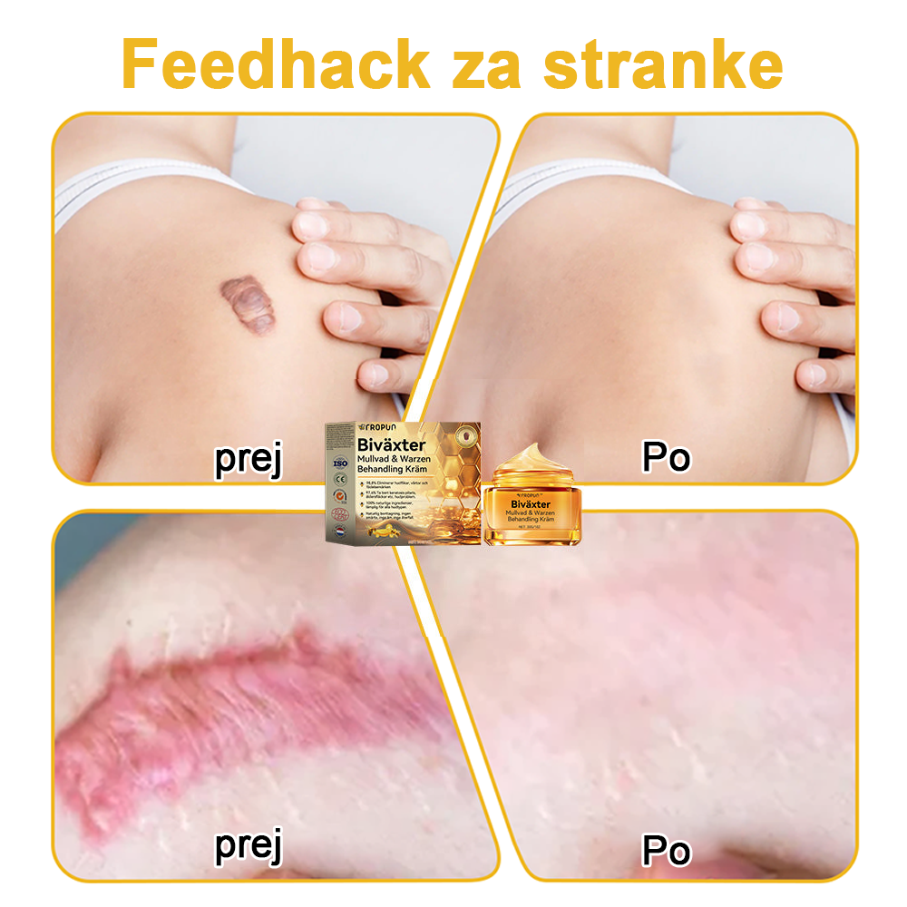 ✨🎁𝑭𝑹𝑶𝑷𝑼𝑵™ krema za odstranjevanje znamenj in madežev (85% popust zadnji dan dogodka)