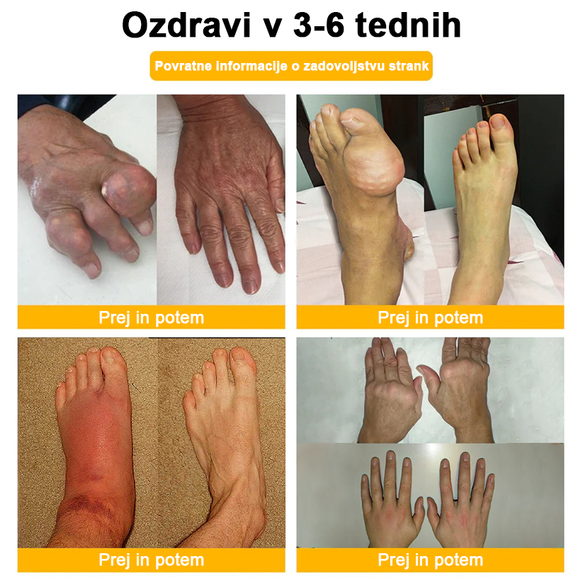 ADNOON™ Krema za lajšanje bolečin in celjenje kosti z botulin toksinom in čebeljim strupom