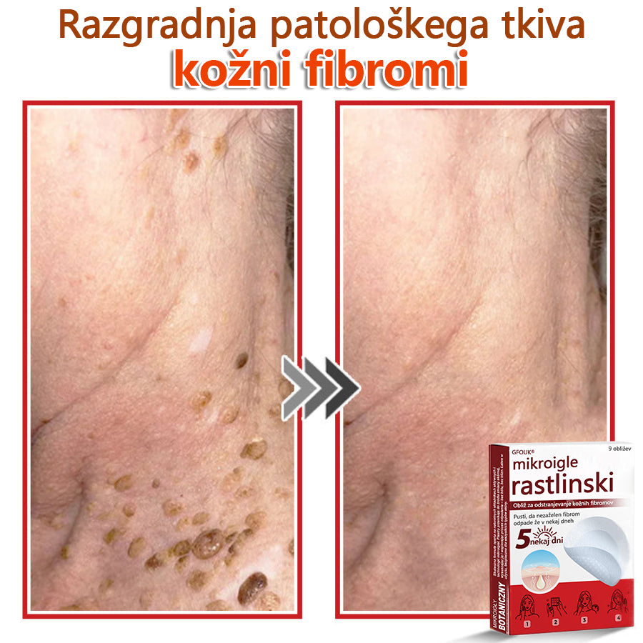 👨⚕️ GFOUK® MicroNeedle obliž za odstranjevanje kožnih izrastkov 🇪🇺 Skupno z EU smernicami za nego kože