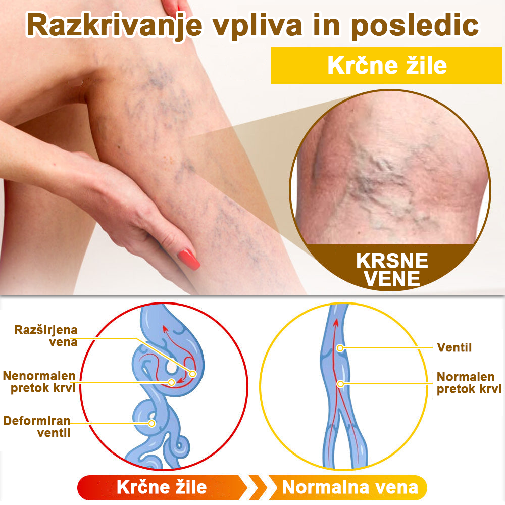 ✅flysmus™ zdravilna krema s čebeljim strupom🐝: Zdravljenje ekcemov, luskavice, aken, rozacee, glivičnih okužb, bradavic