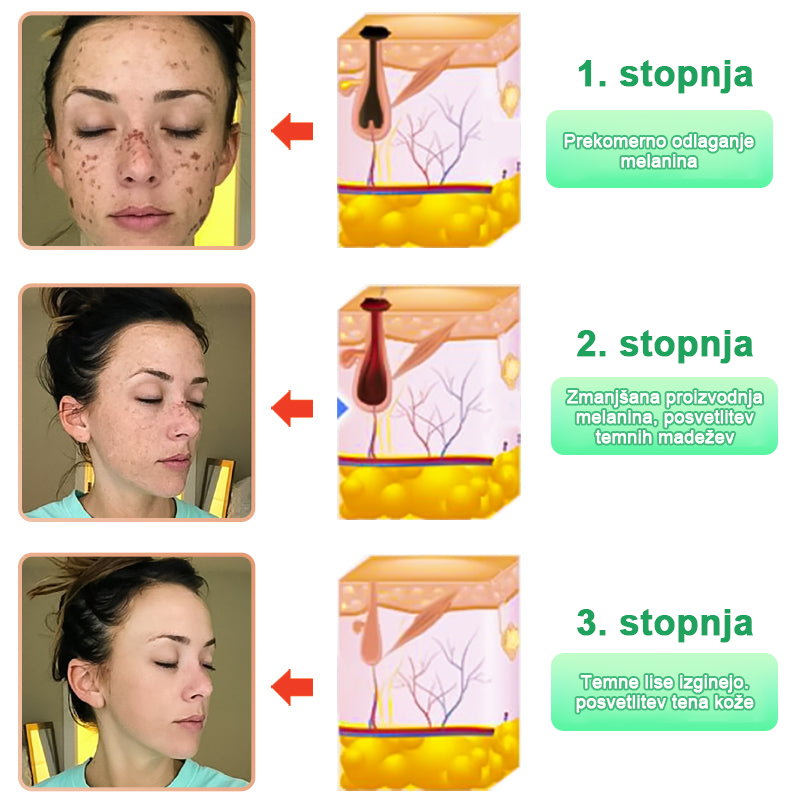 Čistilni piling gel za Acanthosis Nigricans, luščenje, temne madeže, kožne oznake in ekceme