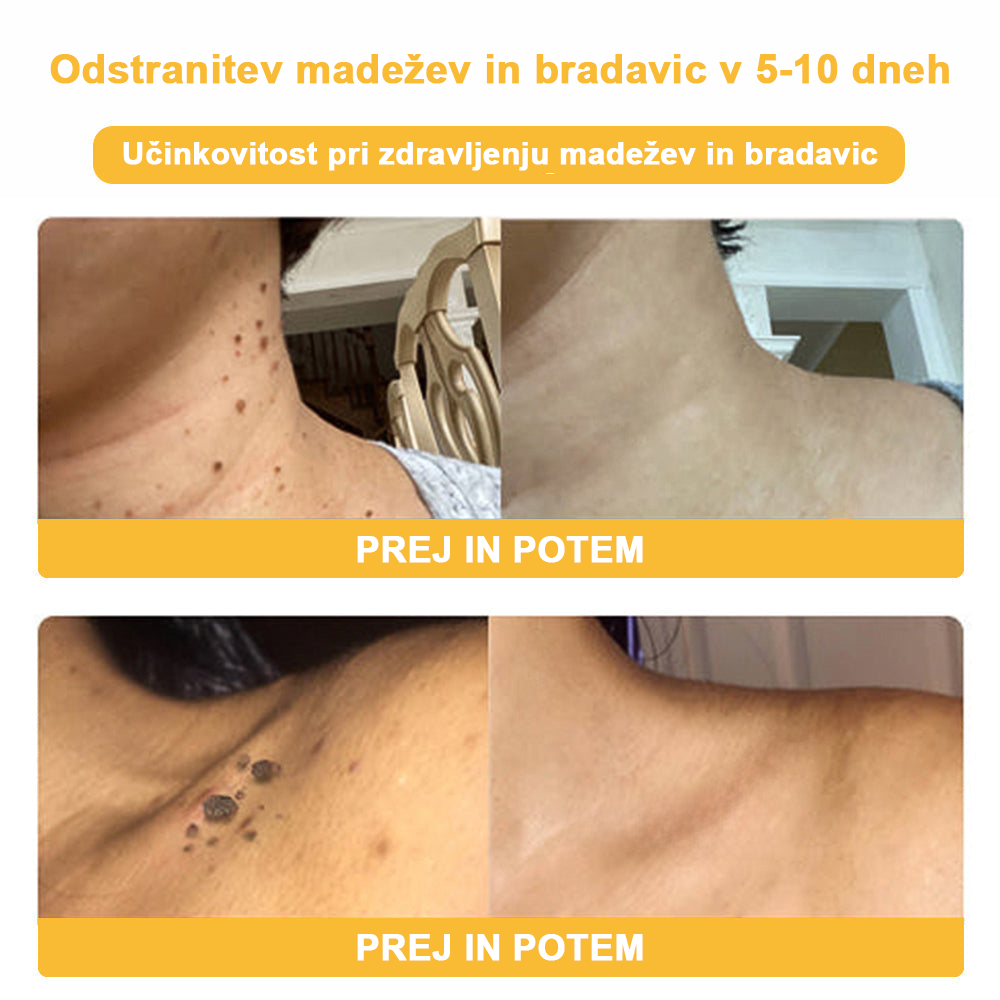 𝑽𝒆𝒍𝒊𝒔𝒔𝒆™ 2024 (priporoča AAD), za odstranjevanje bradavic, aken in brazgotin. Zdravi različne kožne bolezni