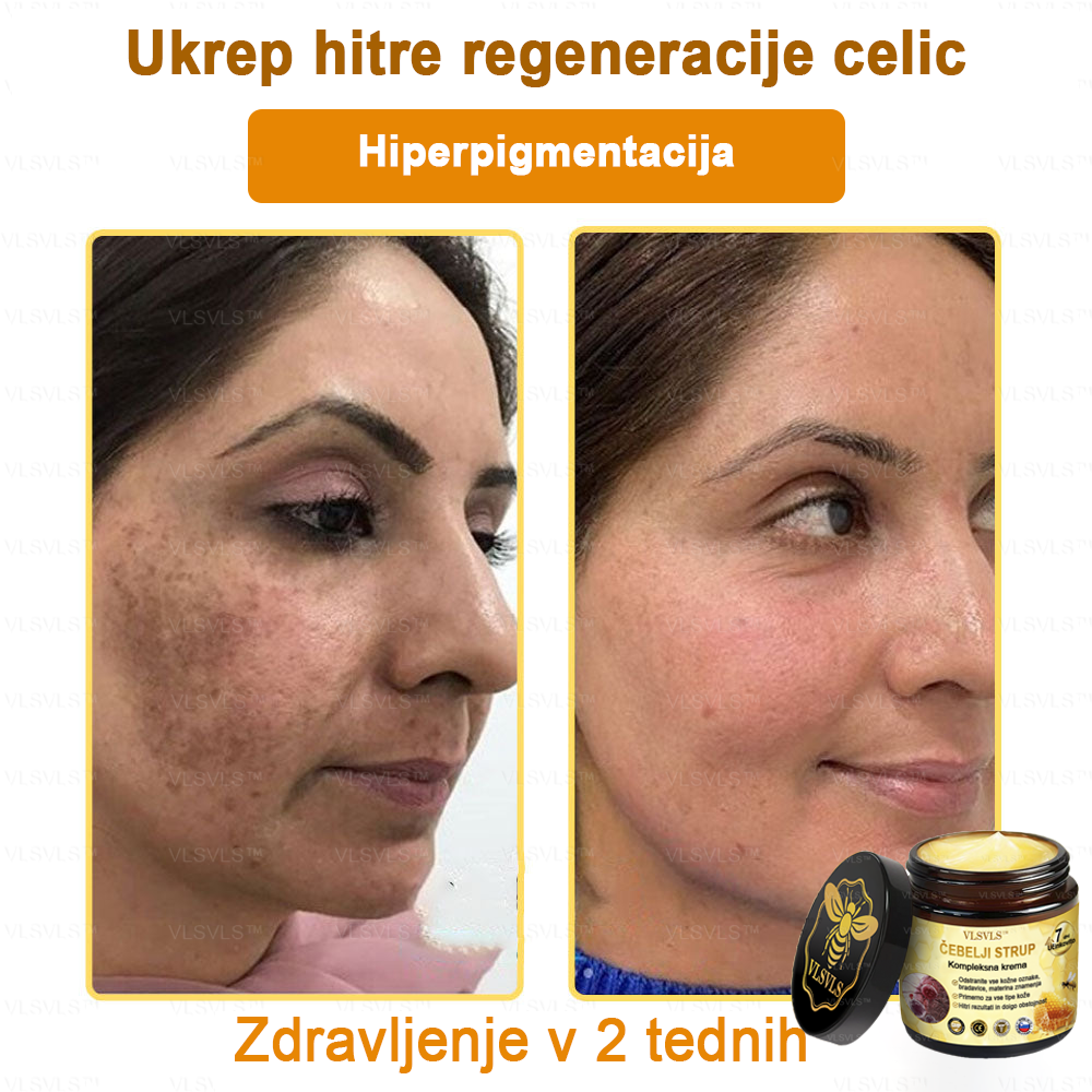 VLSVLS™ krema s čebeljim strupom s polnim učinkom 🧑⚕️ Priporočajo dermatologi - za zdravljenje različnih kožnih težav🐝