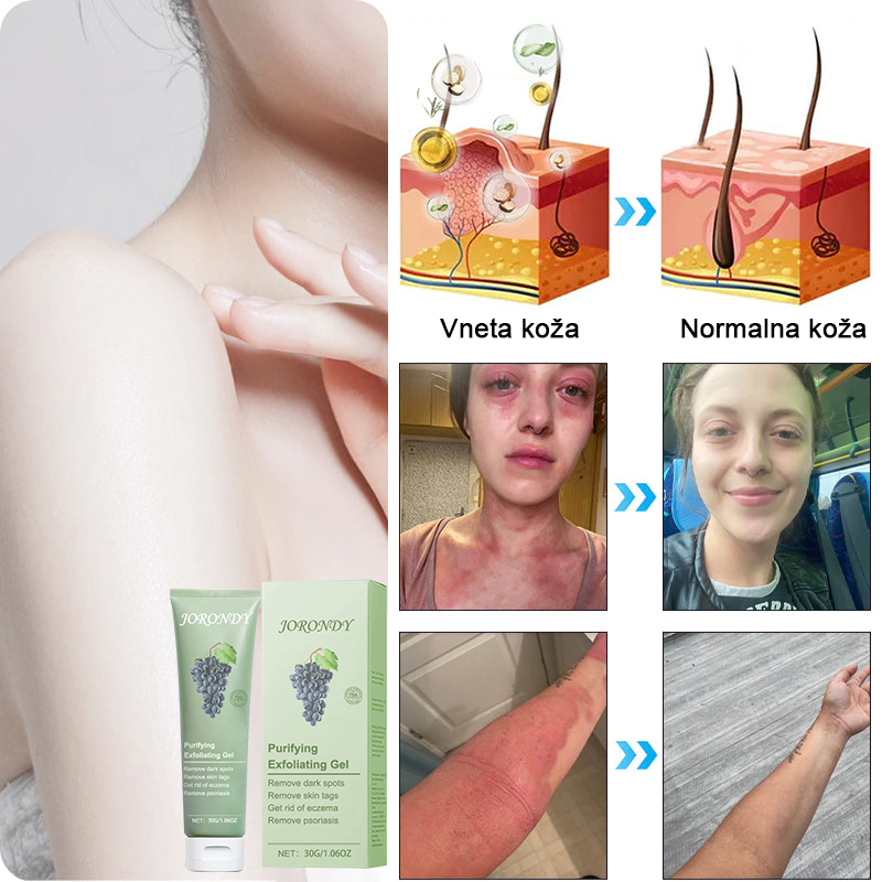 Čistilni piling gel za Acanthosis Nigricans, luščenje, temne madeže, kožne oznake in ekceme