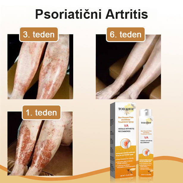 🌿TODAHOF™ Sprej za sklepe s čebeljim strupom💎Primeren za vse starosti🔥 Časovno omejen 75% popust