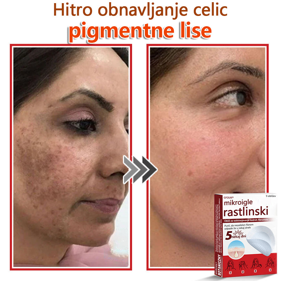 👨⚕️ GFOUK® MicroNeedle obliž za odstranjevanje kožnih izrastkov 🇪🇺 Skupno z EU smernicami za nego kože