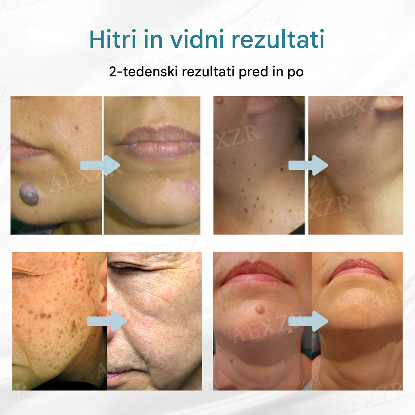 Bikenda® neinvazivno lasersko pero za odstranjevanje madežev in bradavic