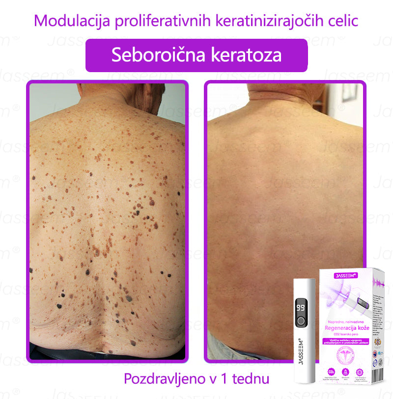 𝐉𝐚𝐬𝐬𝐞𝐞𝐦® Napredni neinvazivni CO₂ laserski pisalo za obnovo kože 🛫 (Nežno odstrani bradavice, materina znamenja, starostne pege in kožne izrastke – brez bolečin in brez kompliciranja!)