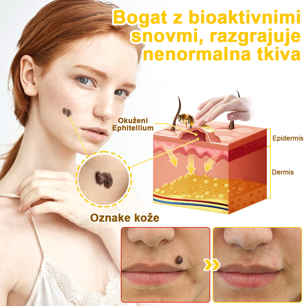 ✅flysmus™ zdravilna krema s čebeljim strupom🐝: Zdravljenje ekcemov, luskavice, aken, rozacee, glivičnih okužb, bradavic