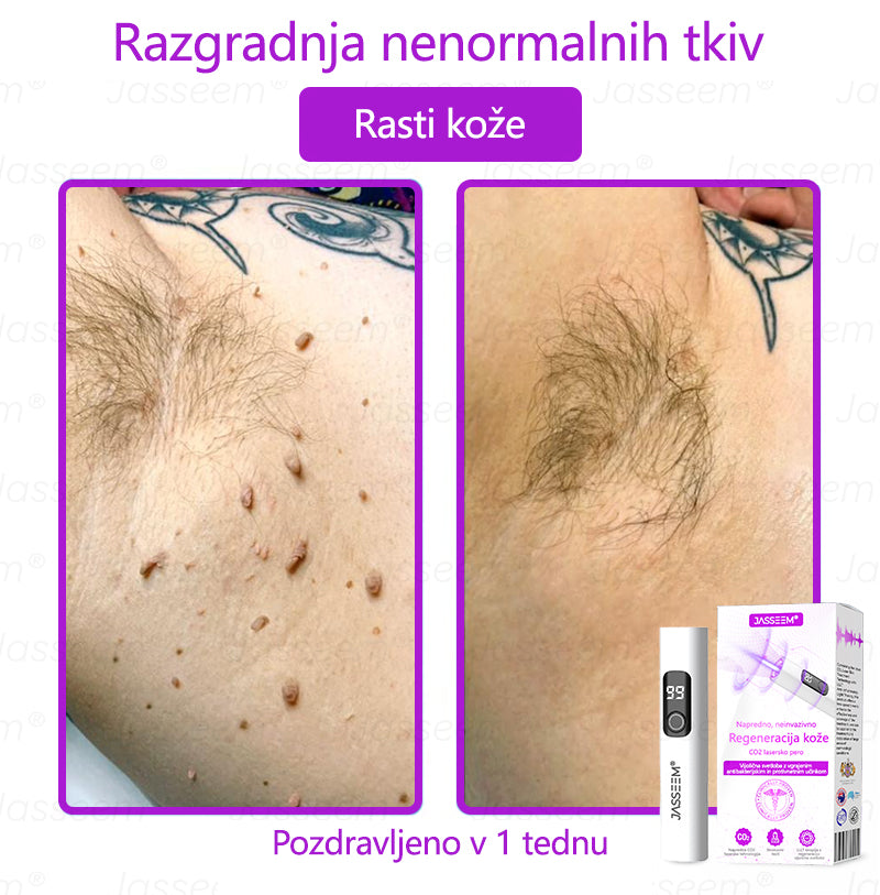 𝐉𝐚𝐬𝐬𝐞𝐞𝐦® Napredni neinvazivni CO₂ laserski pisalo za obnovo kože 🛫 (Nežno odstrani bradavice, materina znamenja, starostne pege in kožne izrastke – brez bolečin in brez kompliciranja!)