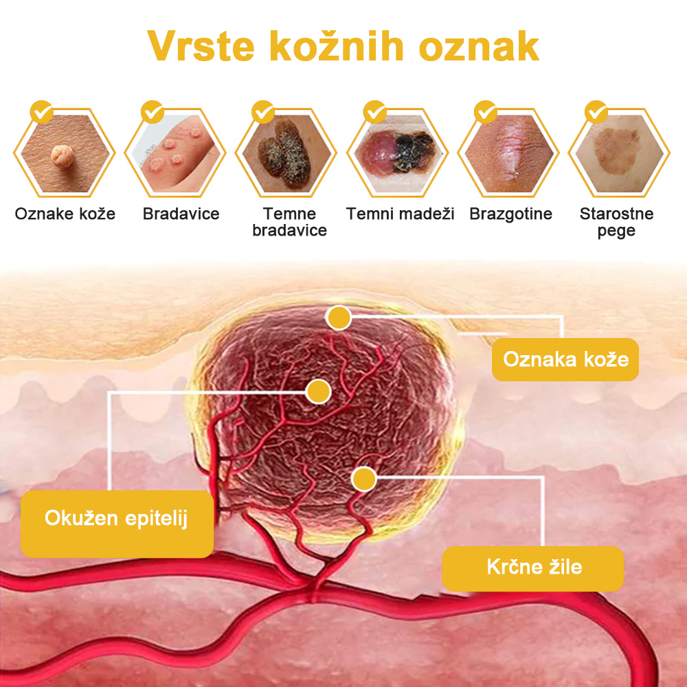 ✨🎁𝑭𝑹𝑶𝑷𝑼𝑵™ krema za odstranjevanje znamenj in madežev (85% popust zadnji dan dogodka)