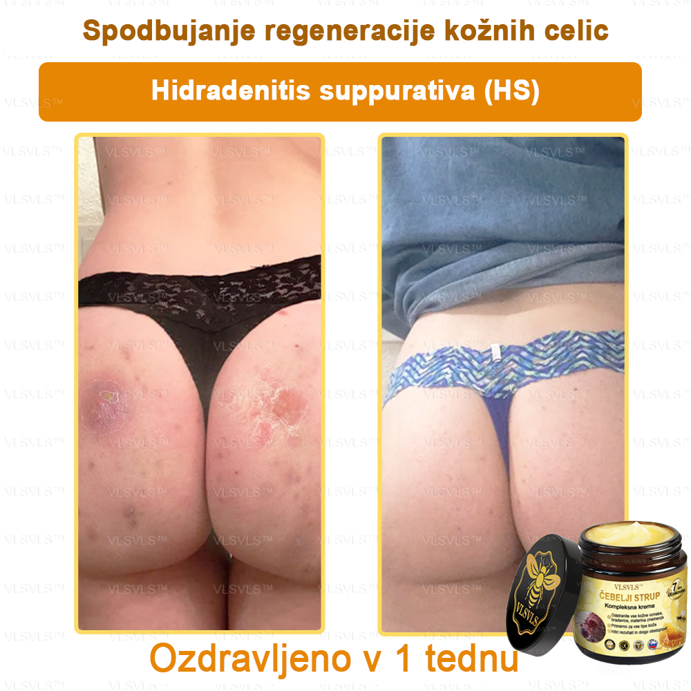 VLSVLS™ krema s čebeljim strupom s polnim učinkom 🧑⚕️ Priporočajo dermatologi - za zdravljenje različnih kožnih težav🐝