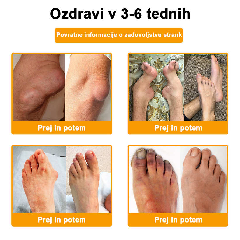 ADNOON™ Krema za lajšanje bolečin in celjenje kosti z botulin toksinom in čebeljim strupom