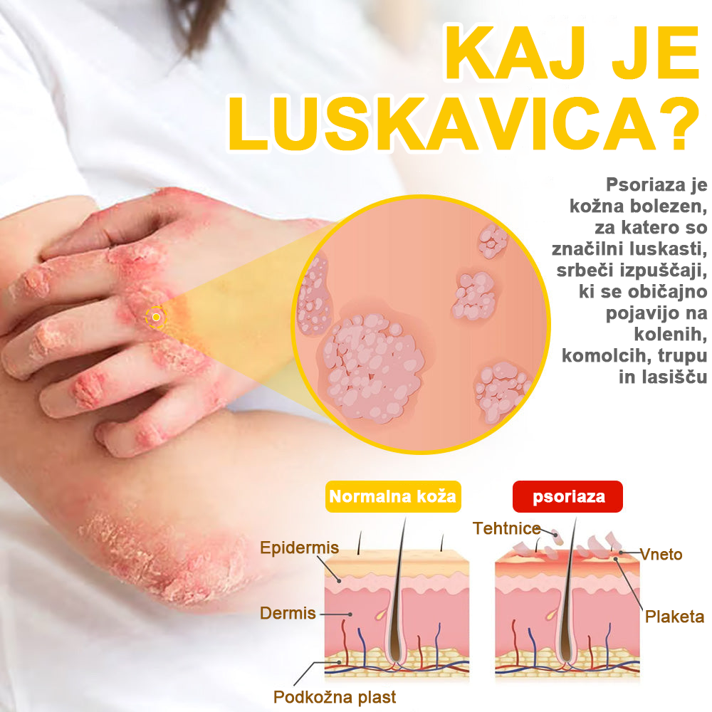 ✅flysmus™ zdravilna krema s čebeljim strupom🐝: Zdravljenje ekcemov, luskavice, aken, rozacee, glivičnih okužb, bradavic