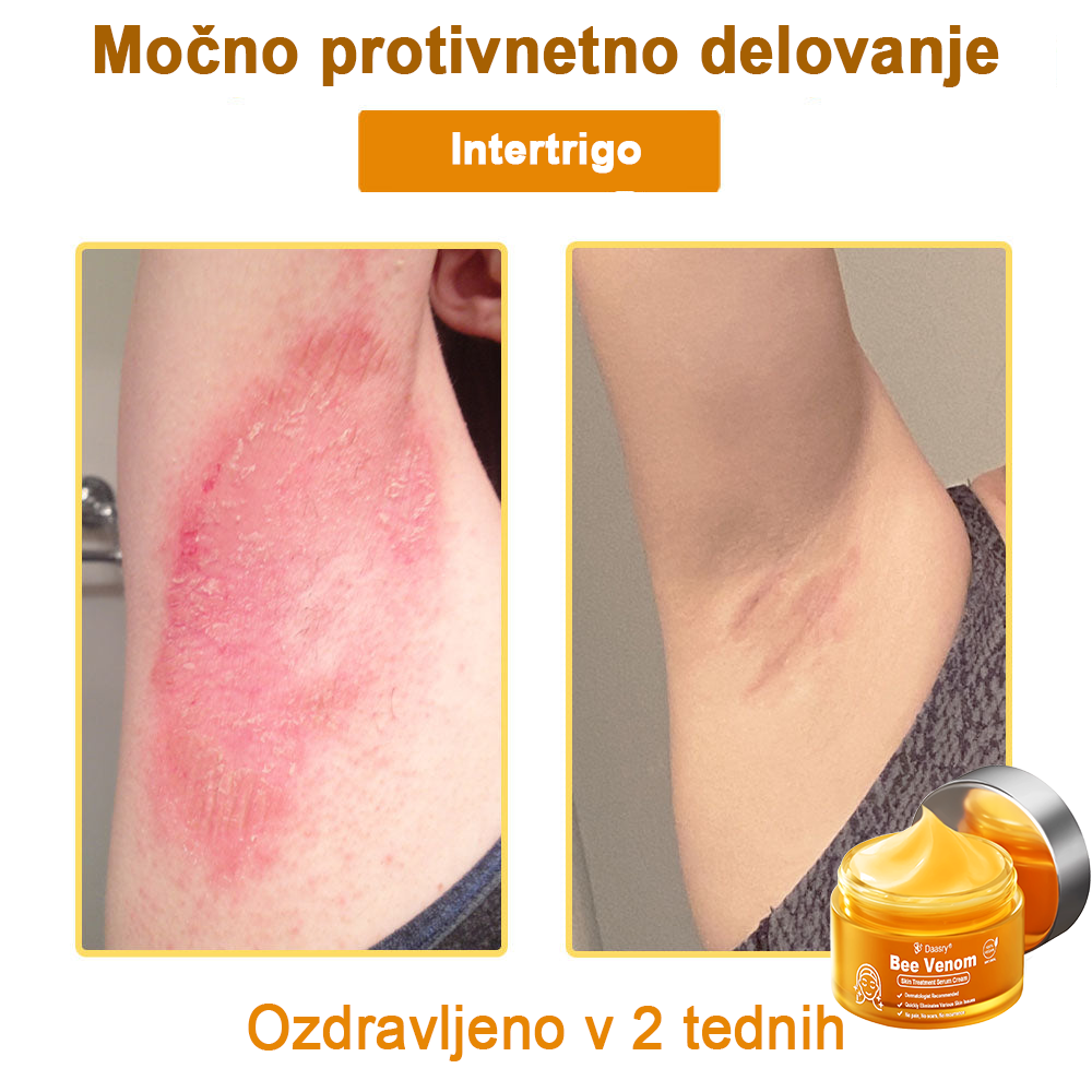 Daasry® Cebelji Strup Kožna Terapija Serum Krema👨⚕️ (Primerno za vse starosti & priporočeno s strani EMA)