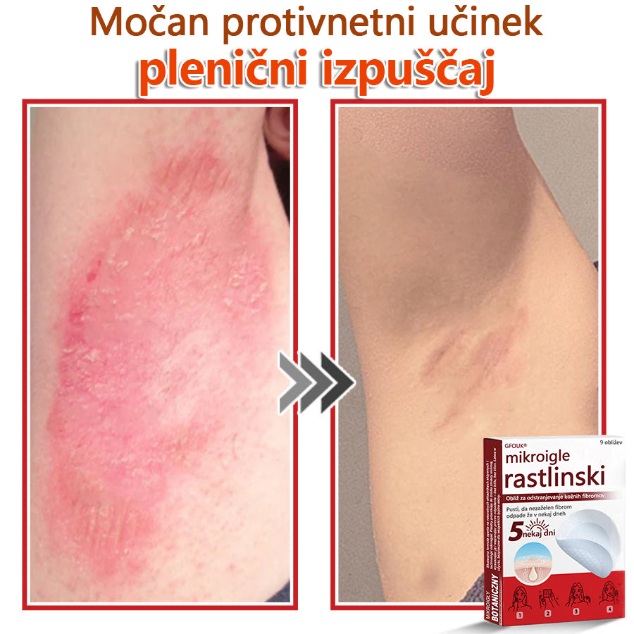👨⚕️ GFOUK® MicroNeedle obliž za odstranjevanje kožnih izrastkov 🇪🇺 Skupno z EU smernicami za nego kože
