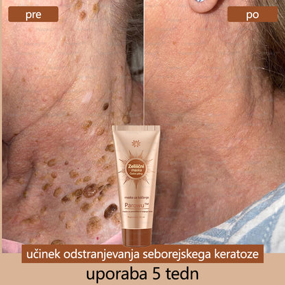 Parowu™ Belilna in Odstranjevalna Maska za madeže - 🍀 Naravne sestavine trajno odstranjujejo pigmentne madeže, starostne pege, pegice in sončne madeže 🔥