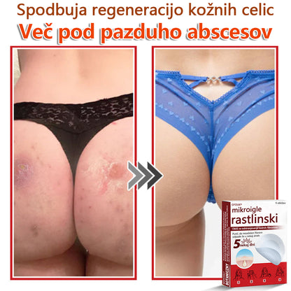 👨‍⚕️ GFOUK® MicroNeedle obliž za odstranjevanje kožnih izrastkov 🇪🇺 Skupno z EU smernicami za nego kože