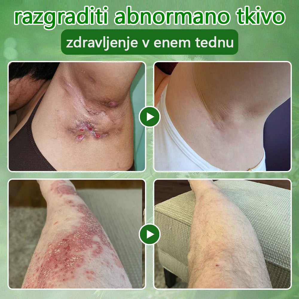 ✅ Certificirano s strani JAZMP 🌿 Zvoevo® Krema z oljem čajevca – Odpravlja nepravilnosti na koži, obnavlja poškodovano kožo, posvetli polt in nudi nego proti staranju 🌳