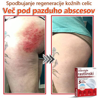 👨‍⚕️ GFOUK® MicroNeedle obliž za odstranjevanje kožnih izrastkov 🇪🇺 Skupno z EU smernicami za nego kože