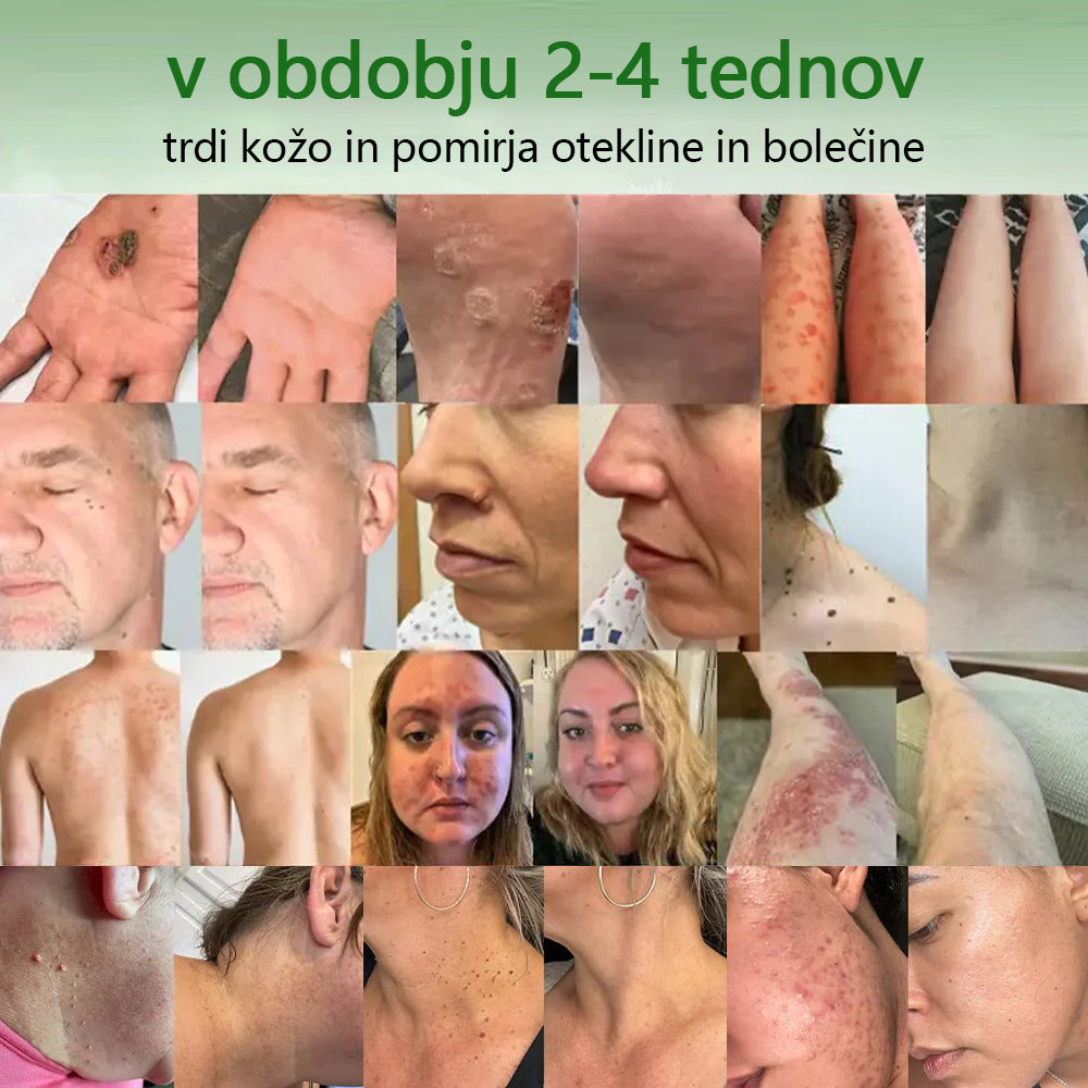 ✅ Certificirano s strani JAZMP 🌿 Zvoevo® Krema z oljem čajevca – Odpravlja nepravilnosti na koži, obnavlja poškodovano kožo, posvetli polt in nudi nego proti staranju 🌳