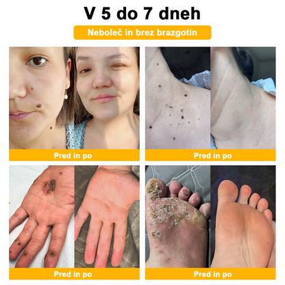 [🌟 gotovina ob dostavi (COD) 🌟] 𝐀𝐰𝐳𝐥𝐨𝐯𝐞™ Krema za zdravljenje madežev in bradavic s čebeljim strupom (priporočila 👨‍⚕AAD)