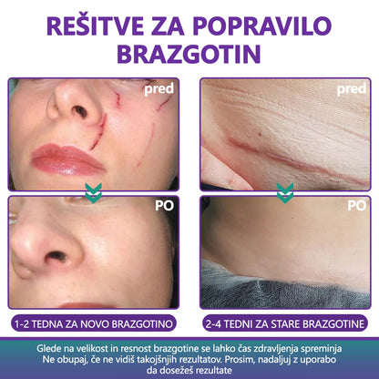 🏷️ Uradna Trgovina: flysmus® ReGen Mikronadlaste Ploščice z Nano-Hialuronsko Kislino (Nano-Heal) 💝 Zdravljenje novih in starih brazgotin, zmanjševanje kirurških brazgotin, strij, keloidov, aken, opeklin, bradavic, dermatomov in krčnih žil