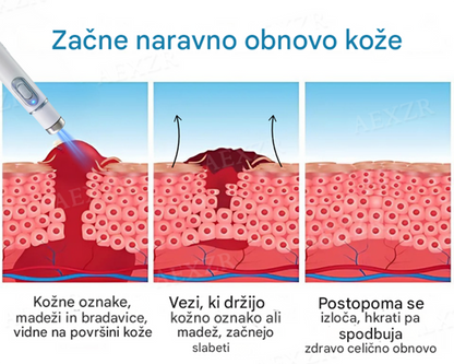 Bikenda® neinvazivno lasersko pero za odstranjevanje madežev in bradavic
