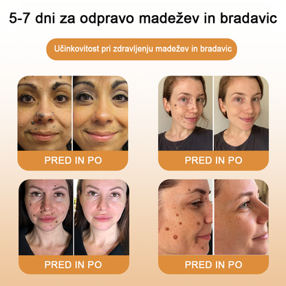 🌺𝙒𝙍𝙀𝙀™ Krema za odstranjevanje bradavic in oznak s čebeljim strupom (👨‍⚕Primerna za vse tipe kože)🐝(🔥Promocija zadnji dan 70% popust)