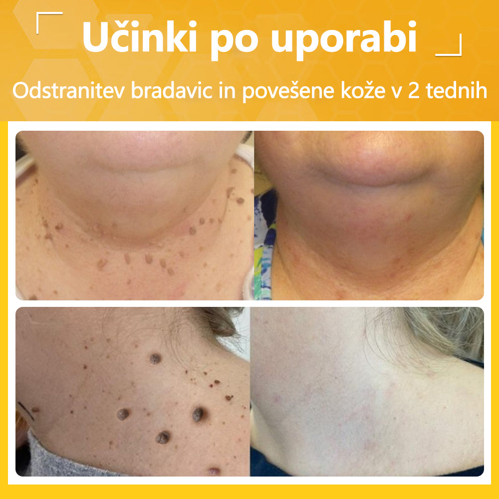 🐝Twinsun™ Izjemno Močna Krema z Čebeljim Strupom, s certifikatom EMA💖 Za zdravljenje bradavic, kožnih izrastkov, okužb in keratoze, ter za glajenje neenakomerne kože