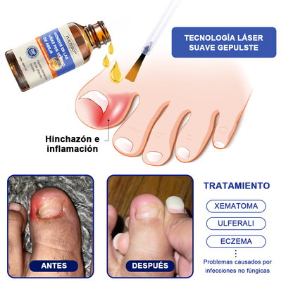 🐝🐝𝐅𝐮𝐫𝐳𝐞𝐫𝐨™Bienengift Nagelpilz Tretma: Popolna rešitev problema glivic na nohtih🌟👣