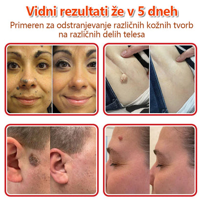 👨‍⚕️ GFOUK® MicroNeedle obliž za odstranjevanje kožnih izrastkov 🇪🇺 Skupno z EU smernicami za nego kože