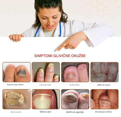 💥 2025 Omejeno 70 % CENEJE ️⏳ Ceoerty® NailRescue Kolirin pršilo proti glivicam s čebeljim strupom 💥 Vse težave z nohti lahko pozdravite v 2 tednih