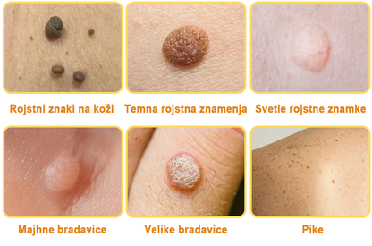 ✨𝐙𝐨𝐞𝐧𝐜𝐠𝐳™ krema s čebeljim strupom za znamenja in bradavice🔥